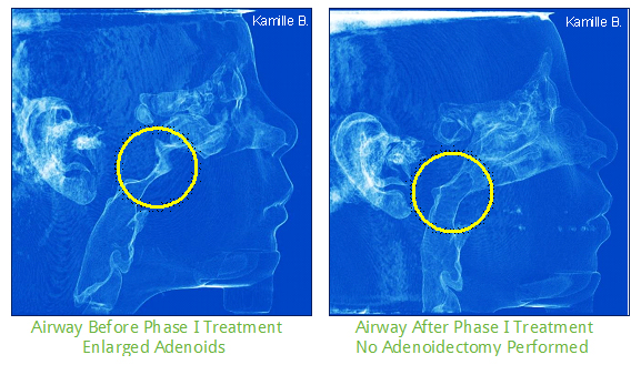 Airway before-after.jpg